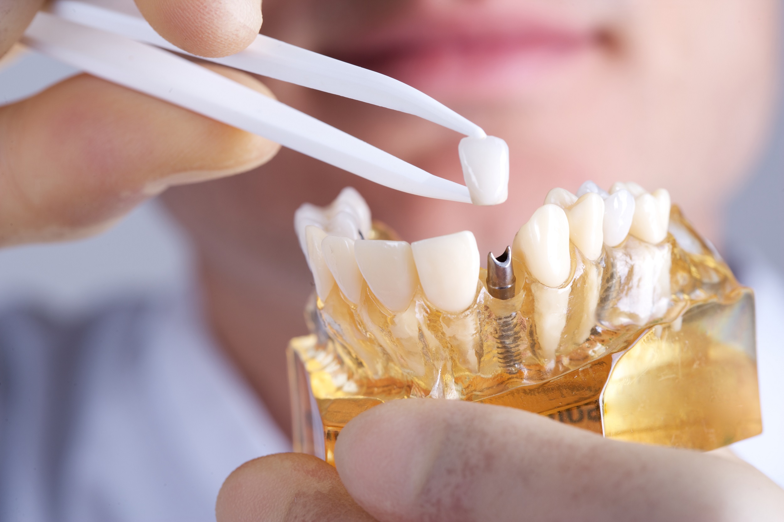 what is involved in a dental implant procedure