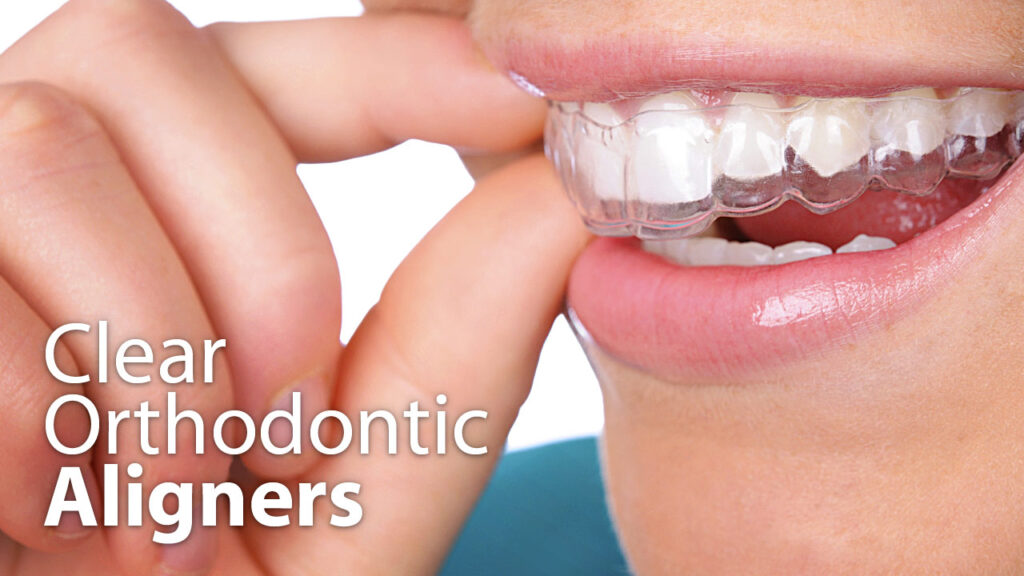 Invisible orthodontics with Invisalign – Somos Dental