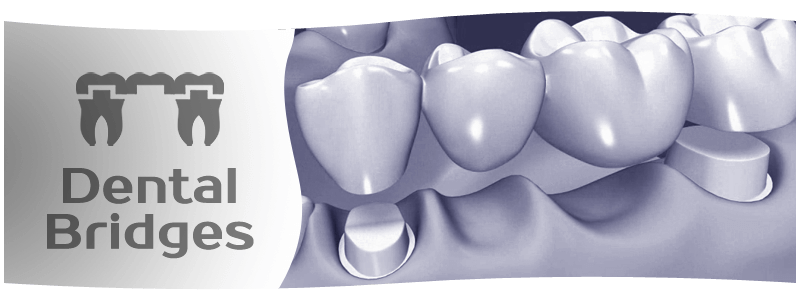 Image illustration of dental bridges in Winnipeg