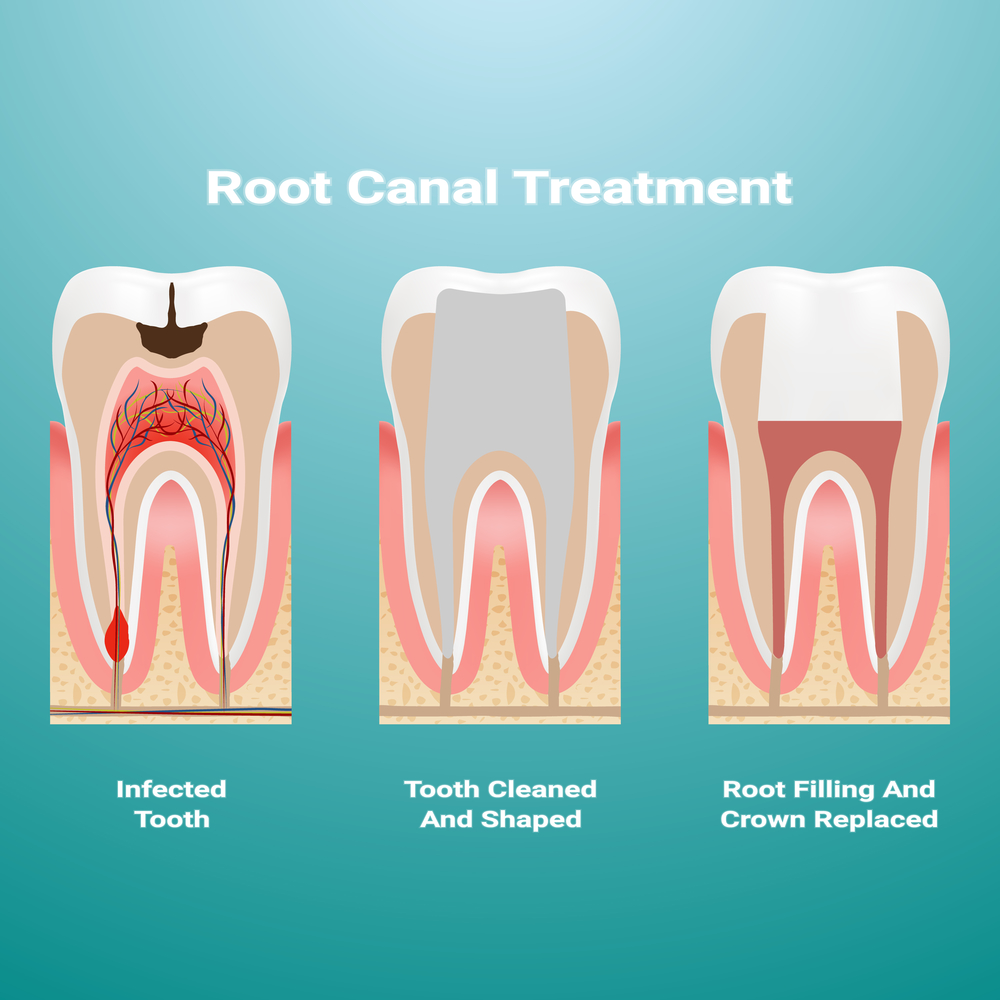 Image illustration of root canals in Winnipeg