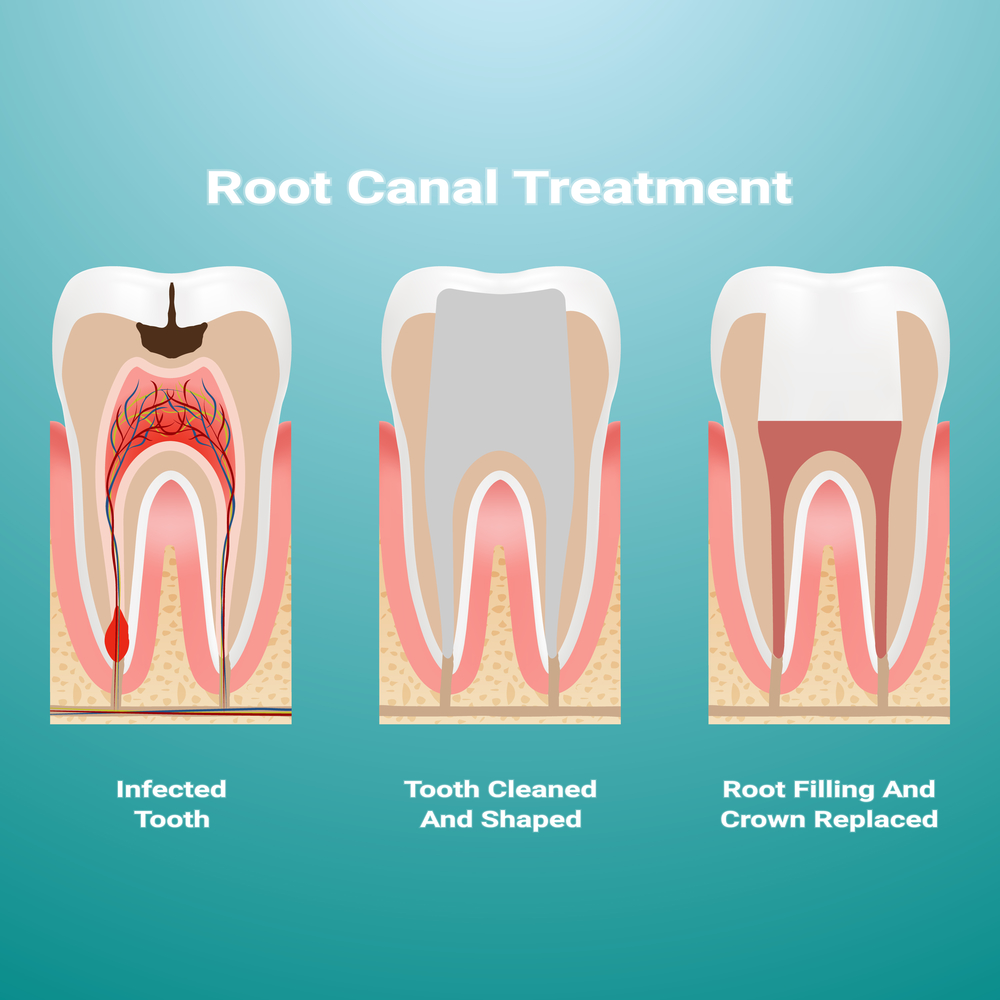 root canals in Winnipeg