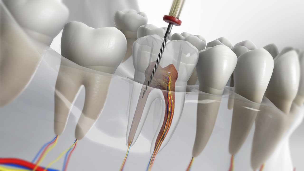 Image illustration of root canal therapy in Winnnipeg