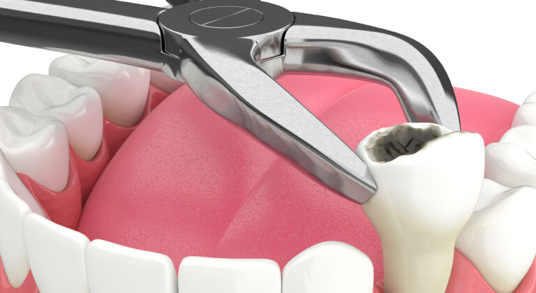 Image illustration of tooth extractions in Winnipeg
