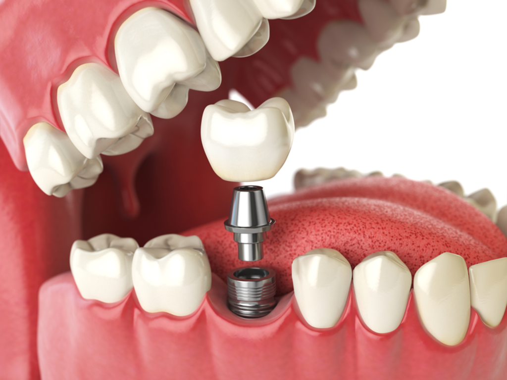 How To Properly Care For Your Dental Implants 3680