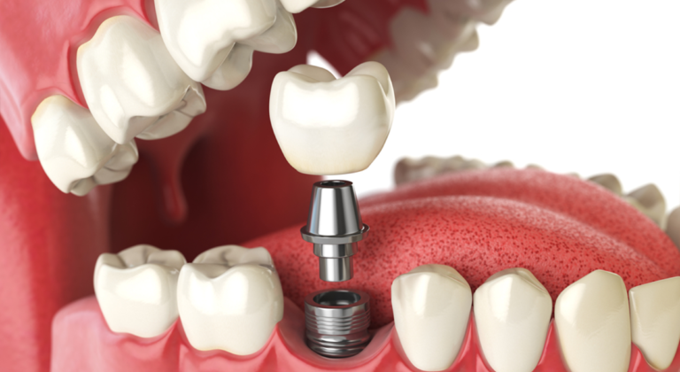 Image illustration of dental implants in Winnipeg
