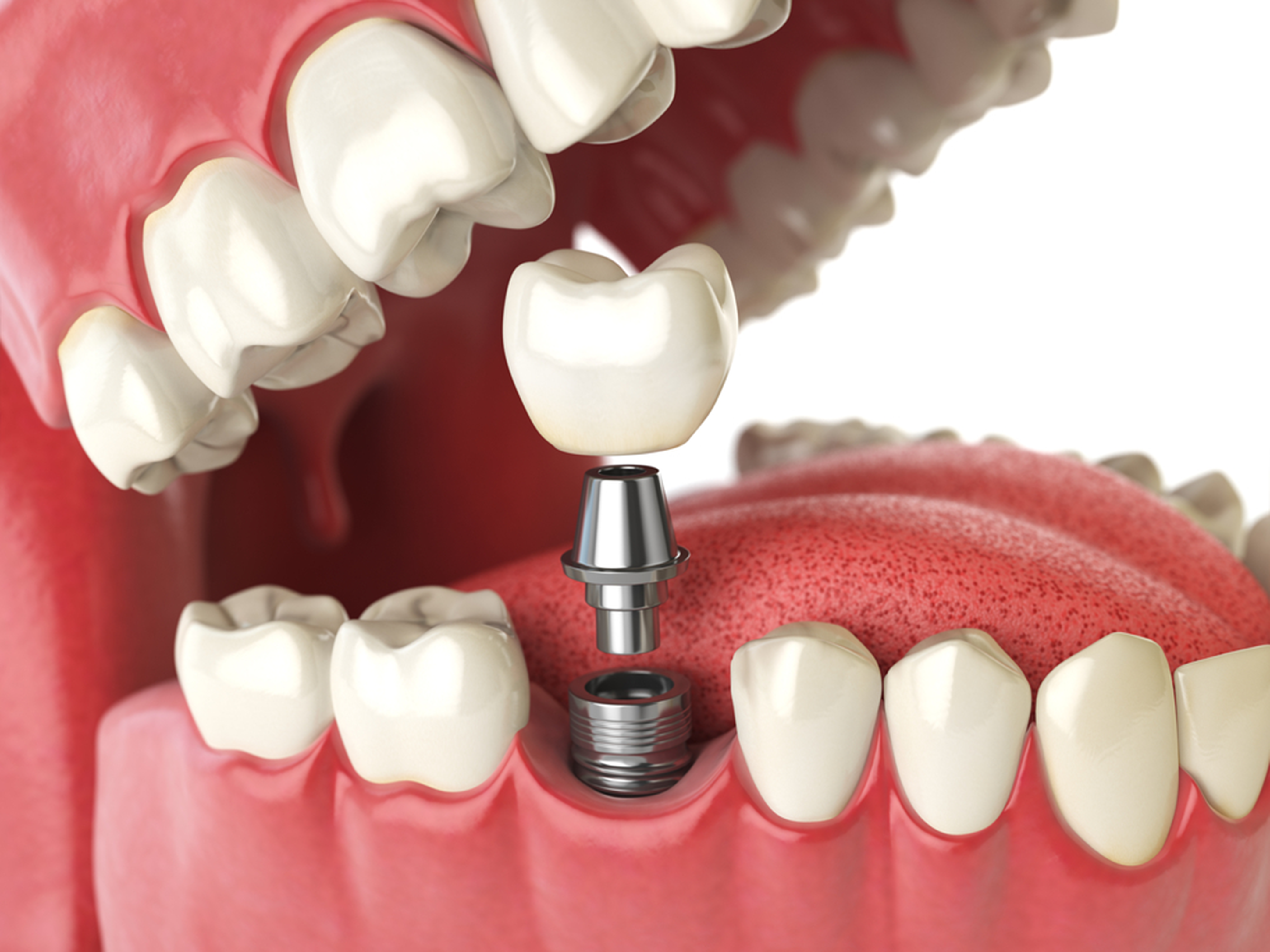 Image illustration of dental implants in Winnipeg