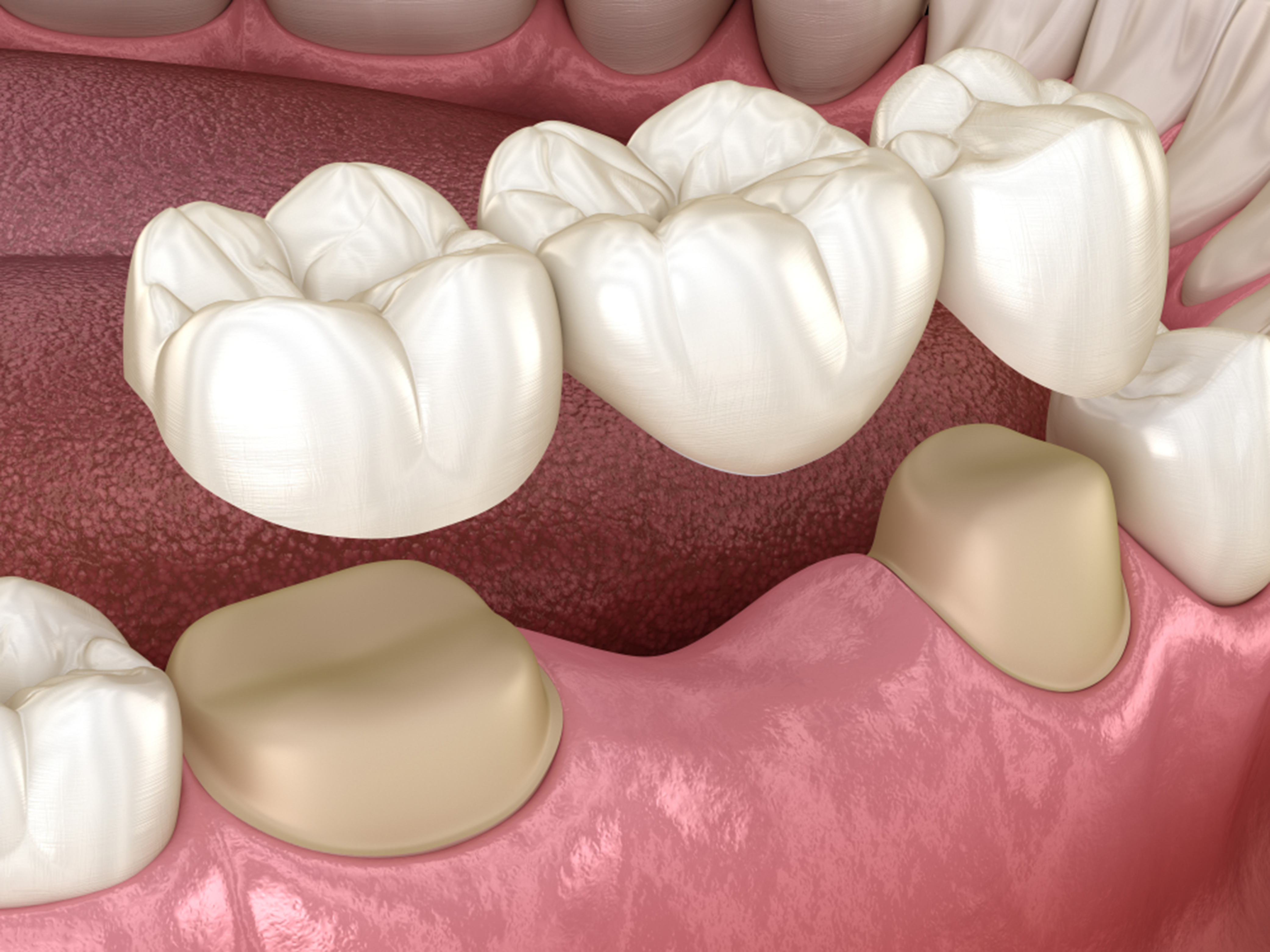 Image illustraation of dental bridges in Winnipeg